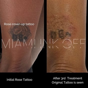 before & after tattoo removal Miami Ink Off 0026