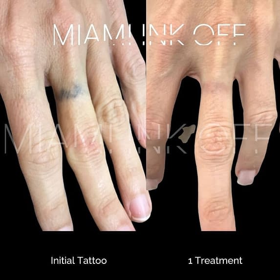 before & after tattoo removal Miami Ink Off 0024