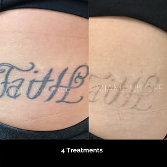 before & after tattoo removal Miami Ink Off 0005