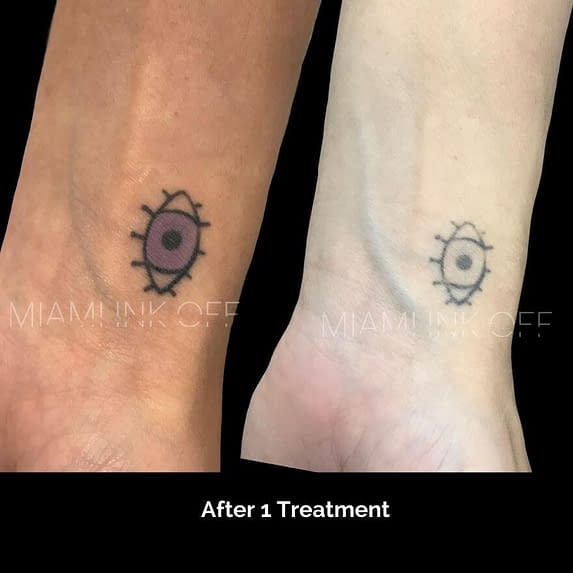 before & after tattoo removal Miami Ink Off 0004
