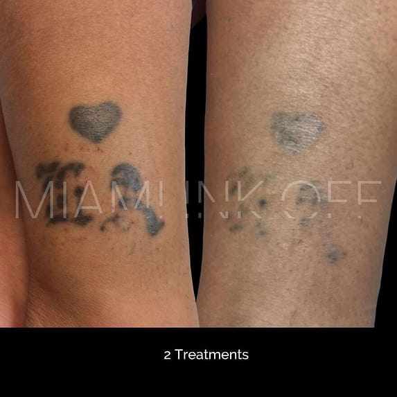 before & after tattoo removal Miami Ink Off 0017