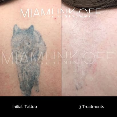 before & after tattoo removal Miami Ink Off 0020