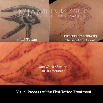 before & after tattoo removal Miami Ink Off 0013