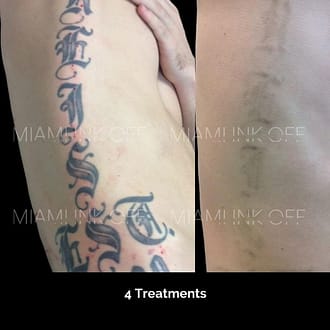 before & after tattoo removal Miami Ink Off 0003
