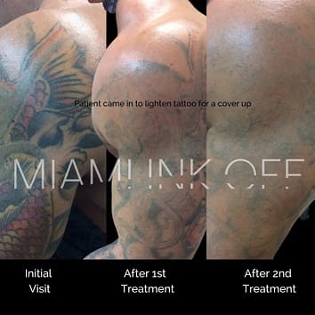 before & after tattoo removal Miami Ink Off 0016