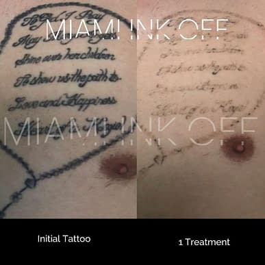 A before and after image of a tattoo being almost completely removed after just one session of Enlighten 3 tattoo removal at Miami Ink Off