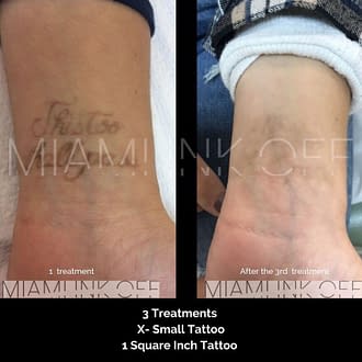 before & after tattoo removal Miami Ink Off 0000
