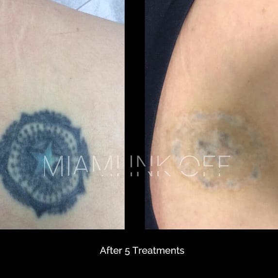 before & after tattoo removal Miami Ink Off 0011