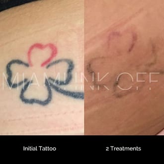 before & after tattoo removal Miami Ink Off 0022