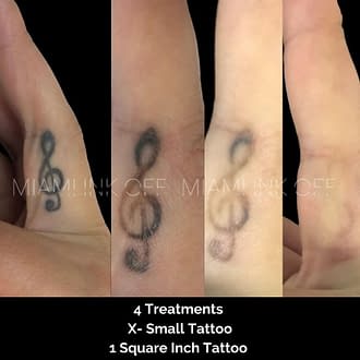 before & after tattoo removal Miami Ink Off 0001