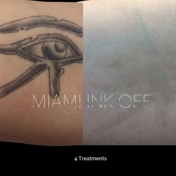 before & after tattoo removal Miami Ink Off 0014