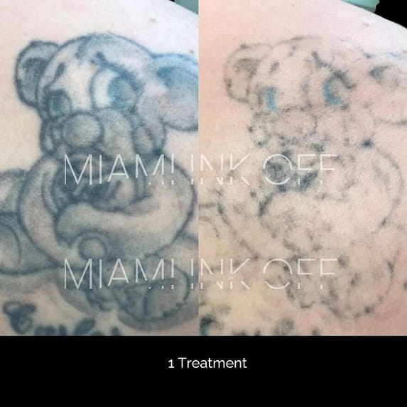 before & after tattoo removal Miami Ink Off 0010