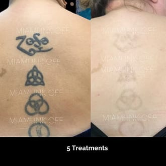 before & after tattoo removal Miami Ink Off 0002