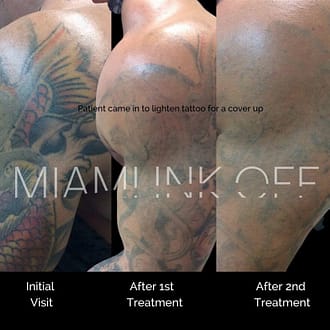 before & after tattoo removal Miami Ink Off 0016
