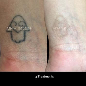 before & after tattoo removal Miami Ink Off 0008