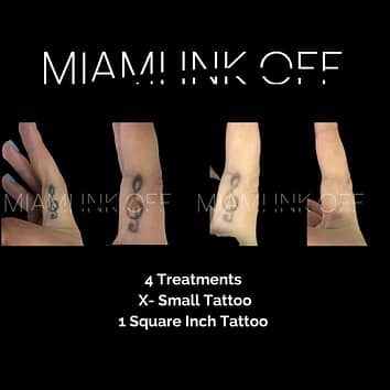 tattoo-removal-before-after-miami-ink-off0002