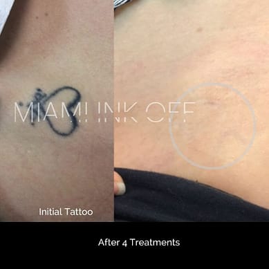 before & after tattoo removal Miami Ink Off 0012