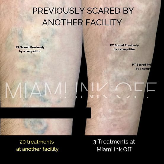 scared before & after tattoo removal Miami Ink Off 0015