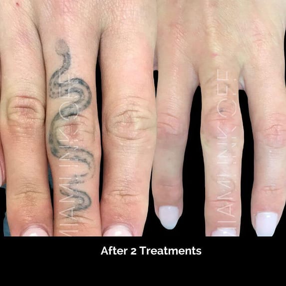 before & after tattoo removal Miami Ink Off 0006
