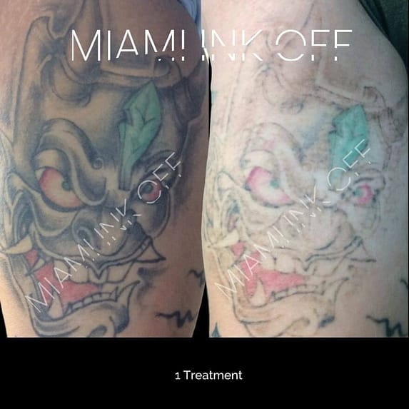 arm tattoo removal miami 1 treatment