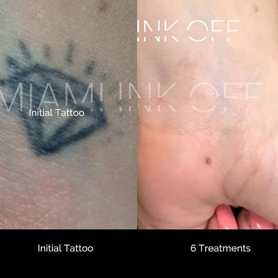 wrist tattoo removal in miami 6 treatments