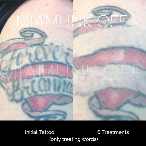 before & after tattoo removal Miami Ink Off 0025