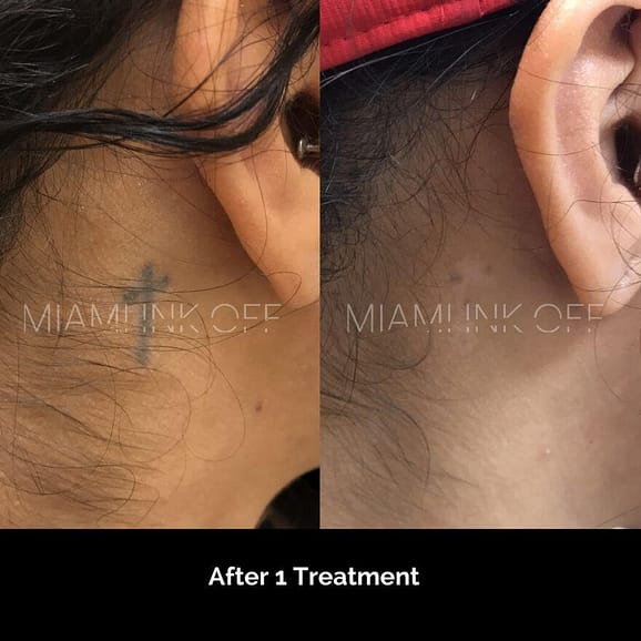 before & after tattoo removal Miami Ink Off 0007
