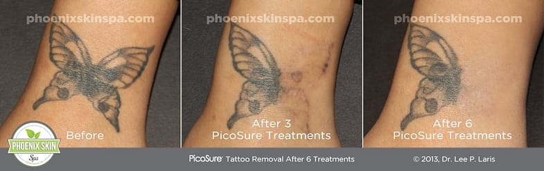 A Before and after picture of a tattoo being partially removed after 5 sessions by the PicoSure Tattoo Removal Laser