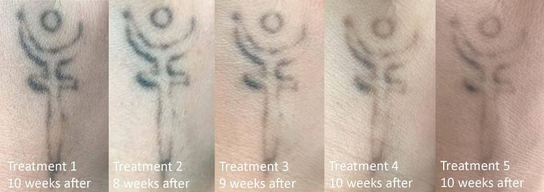 A Before and After image of a tattoo being partially removed using the PicoWay tattoo removal laser