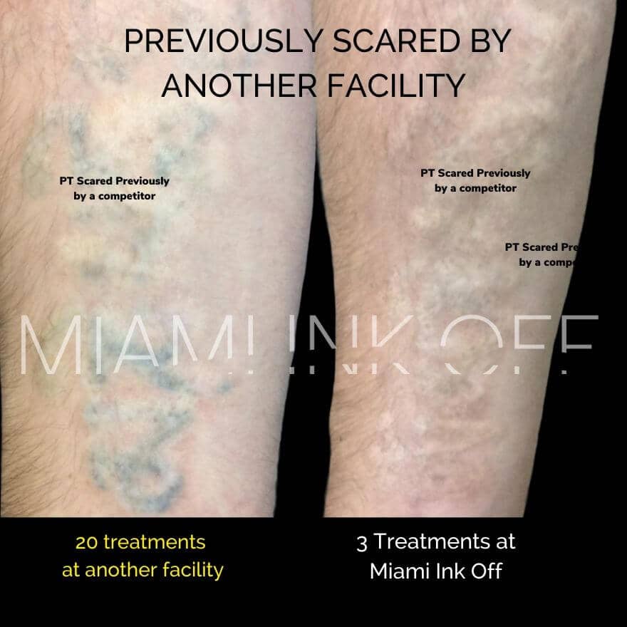 Laser Tattoo Removal | U.S. Dermatology Partners