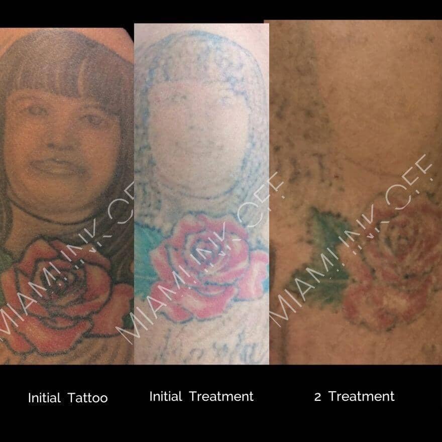 before & after tattoo removal Miami Ink Off 0019