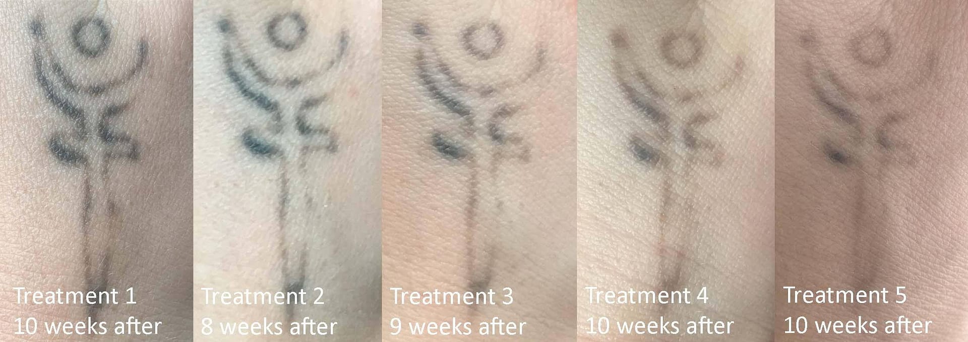3nh Clinivex Picosecond Laser Pen Red Blue Light Therapy Tattoo Scar Mole  Freckle Removal Dark Spot Remover Machine Skin Care Beauty : Amazon.in:  Beauty
